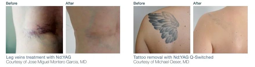 A before and after picture of a tattoo removal procedure.