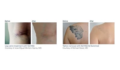 Tattoo Removal & Q-Switched Laser Treatments