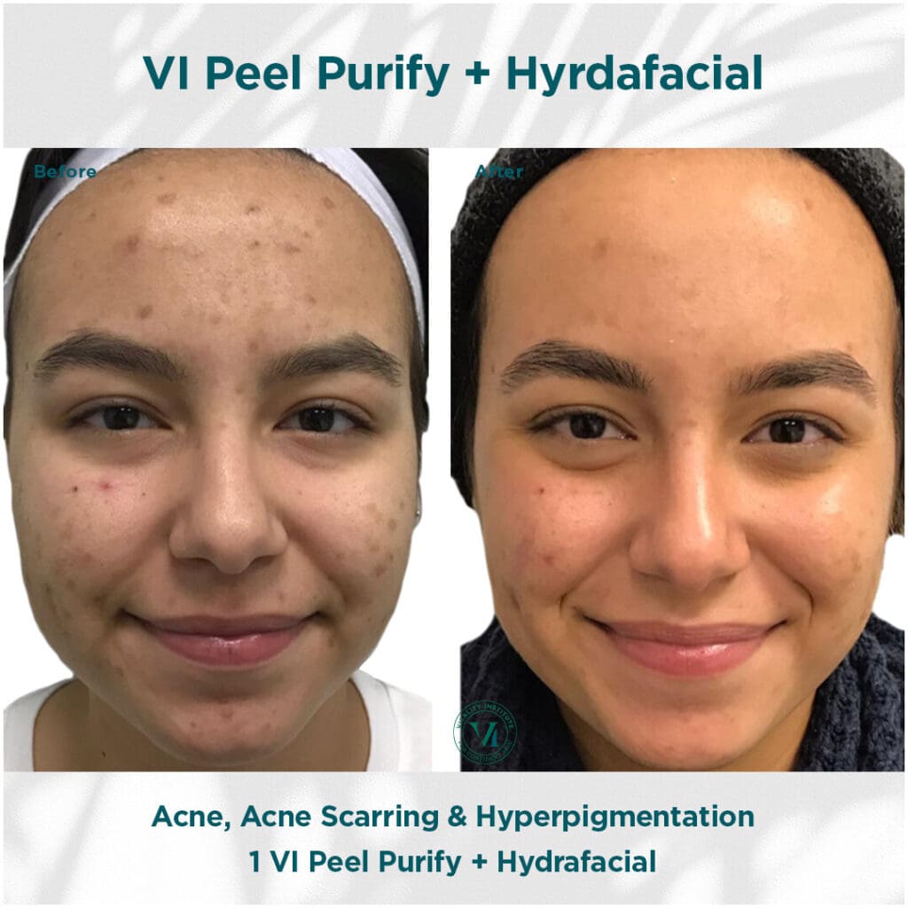 A woman with acne and hyperpigmentation before and after hyrdafacial treatment.