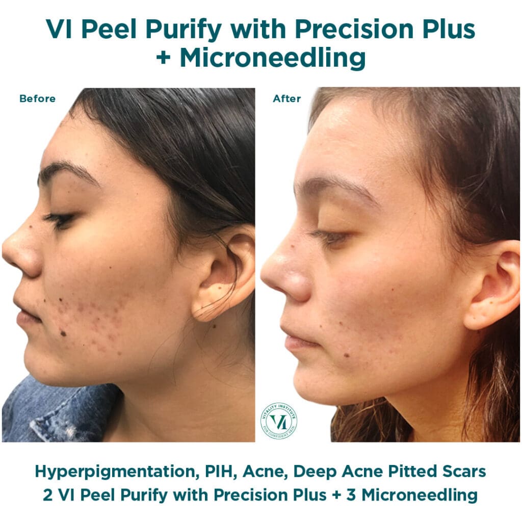 A woman with a facial peel and microneedling