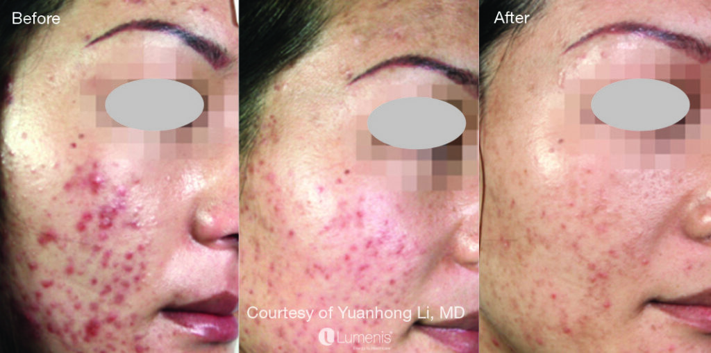 A woman with acne and red spots on her face.