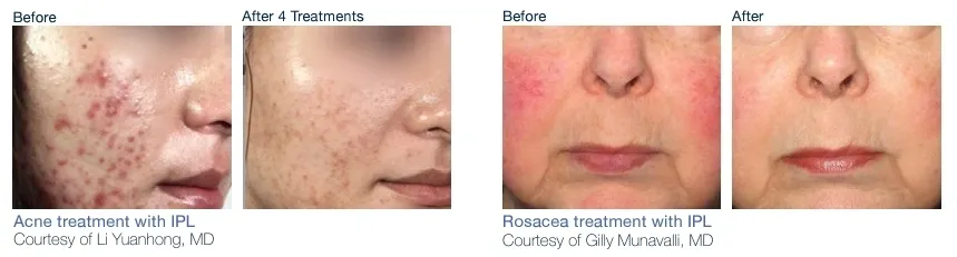 A woman with rosacea is shown before and after treatment.