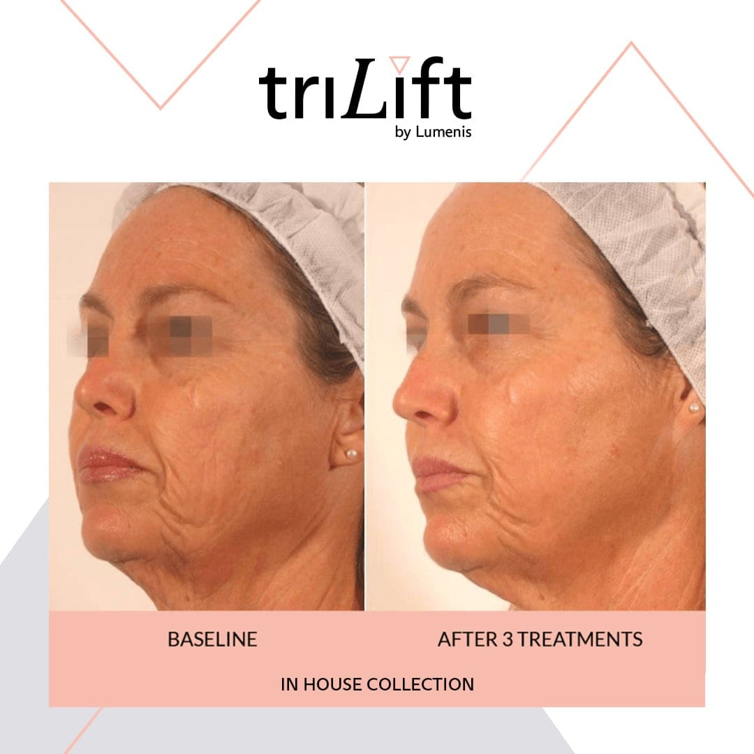 A woman 's face before and after treatment.