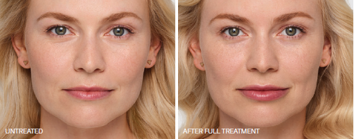 A woman before and after botox treatment.