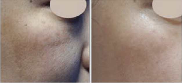 A before and after picture of the skin on a woman 's face.