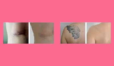 Tattoo Removal & Q-Switched Laser Treatments
